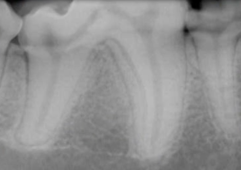 Hors de vue - Radiologie intra-orale