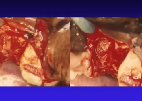 Complications d’extraction : conseils et astuces pour sortir des ennuis!