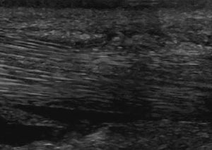 Update on Ultrasound Examination of the Distal Limb