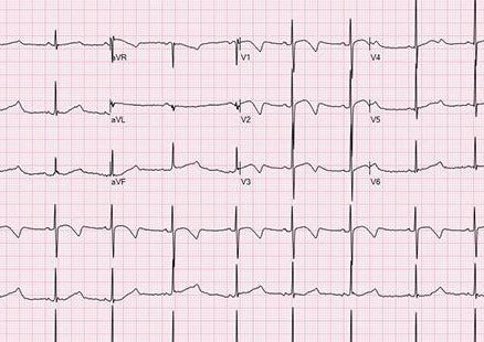 Diagnosis & Management of the Most Common Cardiac Arrhythmias of Dogs & Cats
