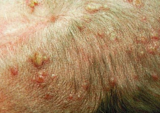 Réactions de médicament défavorables cutanées : blâmez le médicament, pas votre choix !