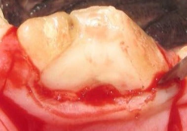 Extractions chirurgicales: engourdissez-le et supprimez-le!