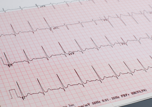 The beat goes on… or not. ECGs and Holter monitors in general practice