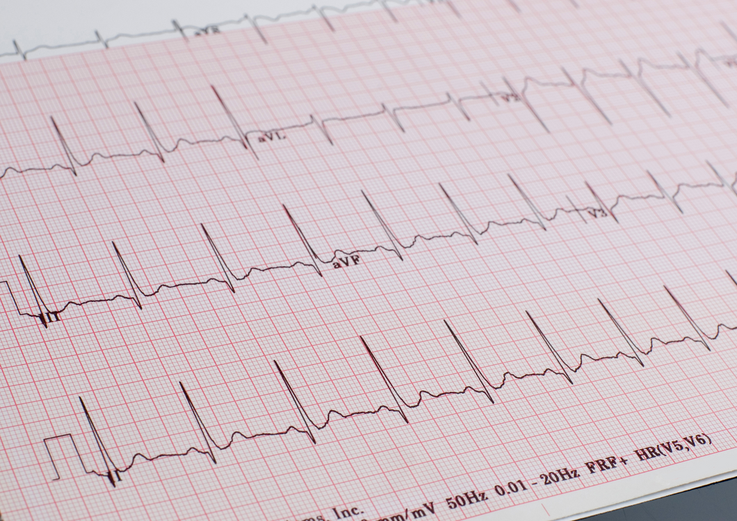 The beat goes on - or not. ECGs and Holter monitors in general practice