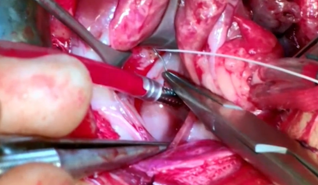 Gestion de la valve Mitral