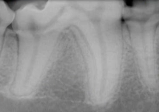 Hors de vue - Radiologie intra-orale