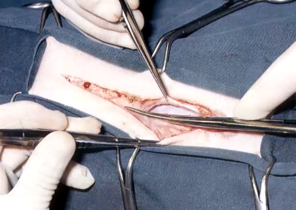 Chirurgie abdominale - meilleurs conseils pour prévenir les complications