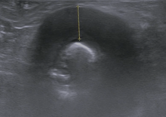Blood and Guts - Assessment of the Patient with GI Bleeding